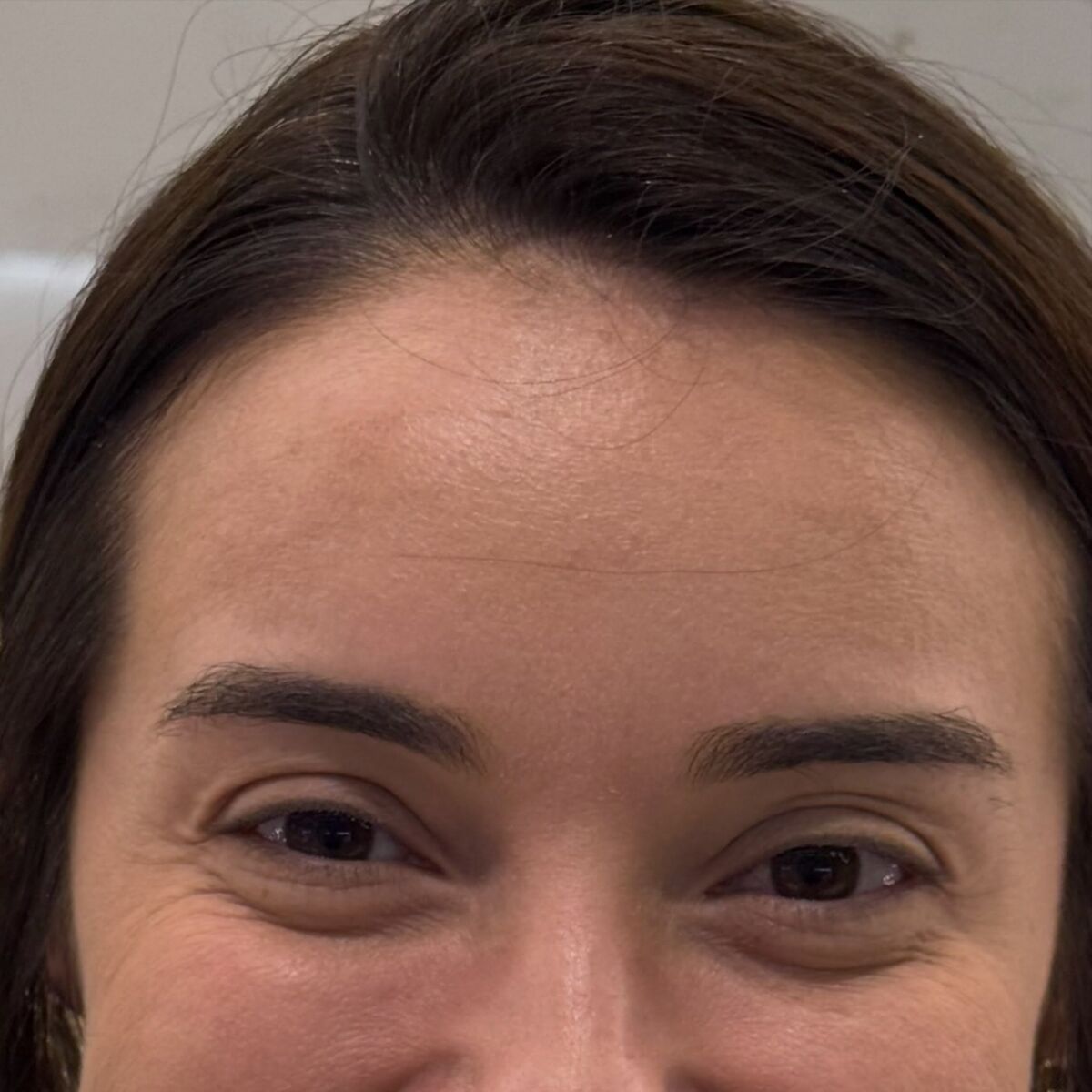 Região dos olhos depois